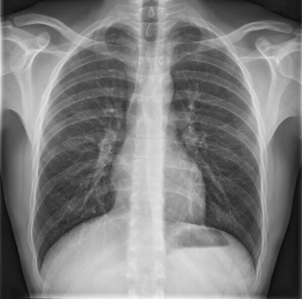 Bizkarrezur torazikoko osteokondrosia erradiografia erabiliz diagnostikatzen da