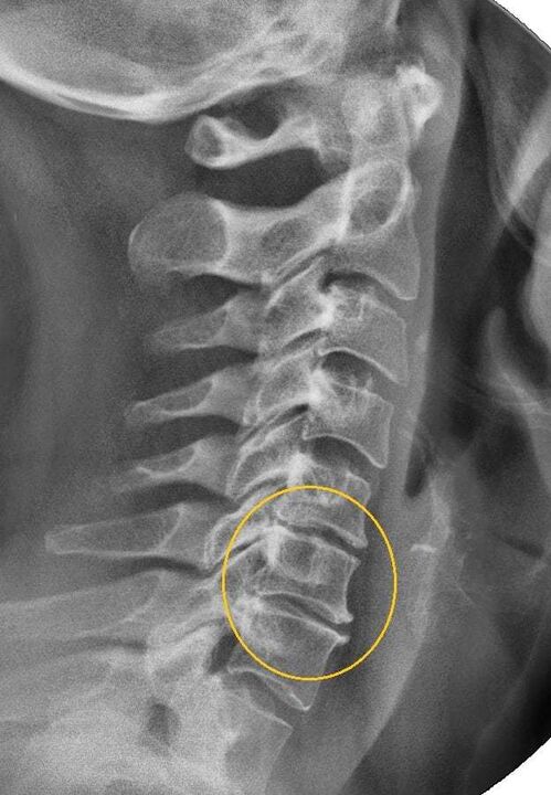 Osteokondrosia