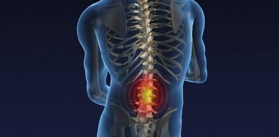 Bizkarreko mina lumbararen osteochondrosisarekin