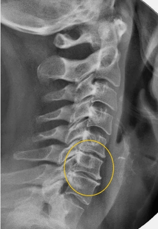 Bizkarrezurreko bizkarrezurraren osteokondrosia x -Ray batean