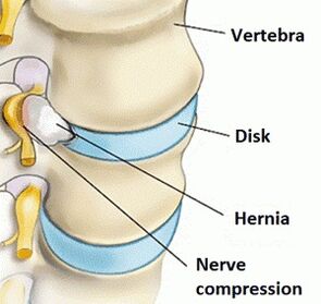 Cervical eskualdeko osteokondrosia