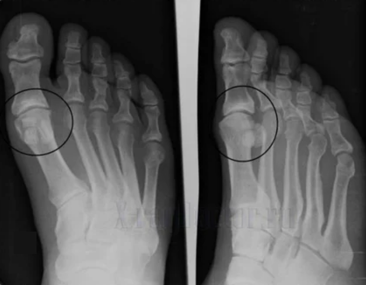 Artrosiaren diagnostikoa