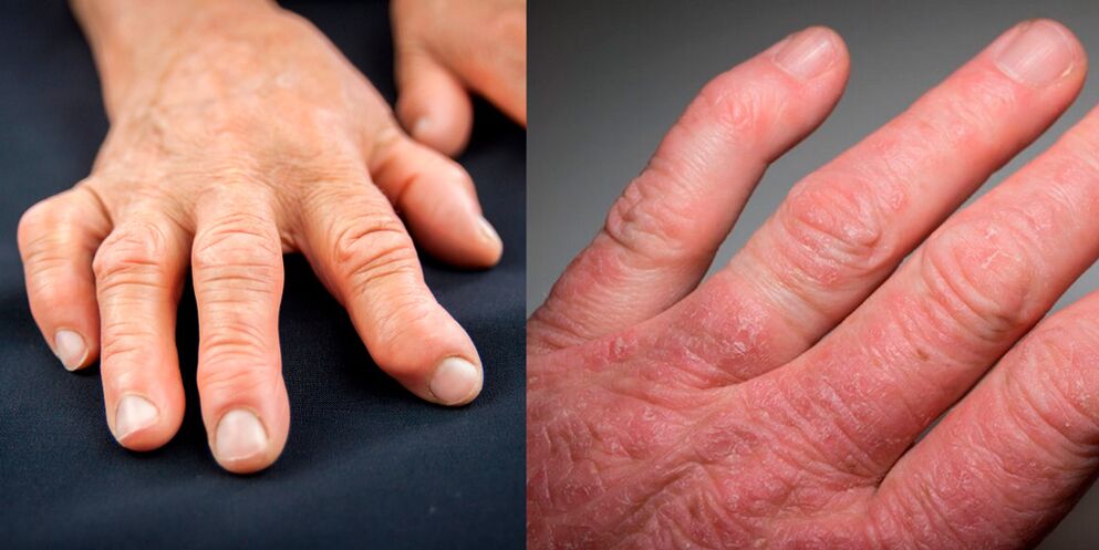 eskuetako artritis erreumatoidea eta psoriasikoa