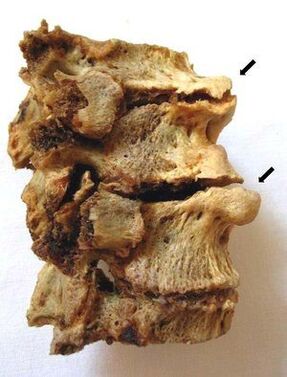 Osteokondrosiak eragindako orno-atala