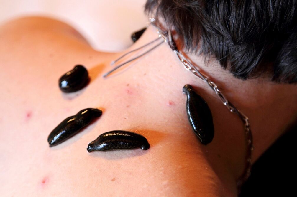 osteokondrosi zerbikalerako leeches