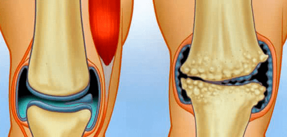 Joint eta Artrosia Normala